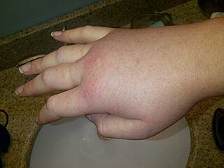 Mano derecha hinchada durante un ataque de angioedema hereditario.