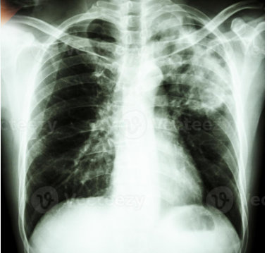 La radiografía de tórax de la película muestra un infiltrado alveolar en la parte superior del pulmón izquierdo debido a una infección por Mycobacterium tuberculosis tuberculosis pulmonar.