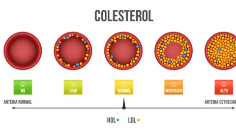 En la mayoría de los casos, el colesterol es consecuencia de una dieta poco saludable y una vida sedentaria, aunque también puede tener un origen genético.