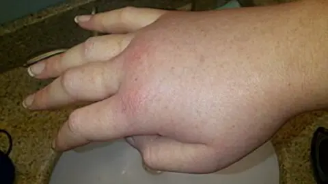 Mano derecha hinchada durante un ataque de angioedema hereditario.