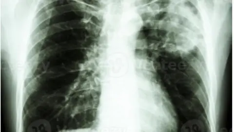 La radiografía de tórax de la película muestra un infiltrado alveolar en la parte superior del pulmón izquierdo debido a una infección por Mycobacterium tuberculosis tuberculosis pulmonar.