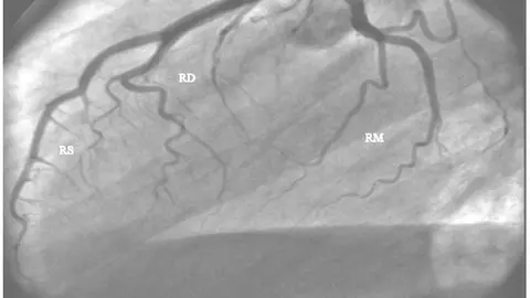 Arteria coronaria izquierda. Anatomía normal. ADA: Arteria descendente anterior; RD: diagonal de Rama; RS: Ramas septales; ACX: Arteria circunfleja; RM: Ramas marginales o laterales.