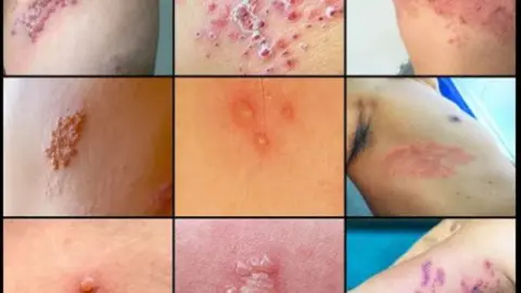 El herpes zóster, una enfermedad que afecta a 11.000 personas cada año.